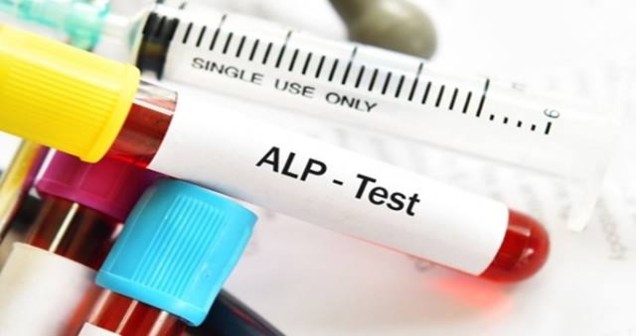 Alkalen Fosfataz Yüksekliği Ne Anlama Gelir? Nedenleri ve Yorumlanması